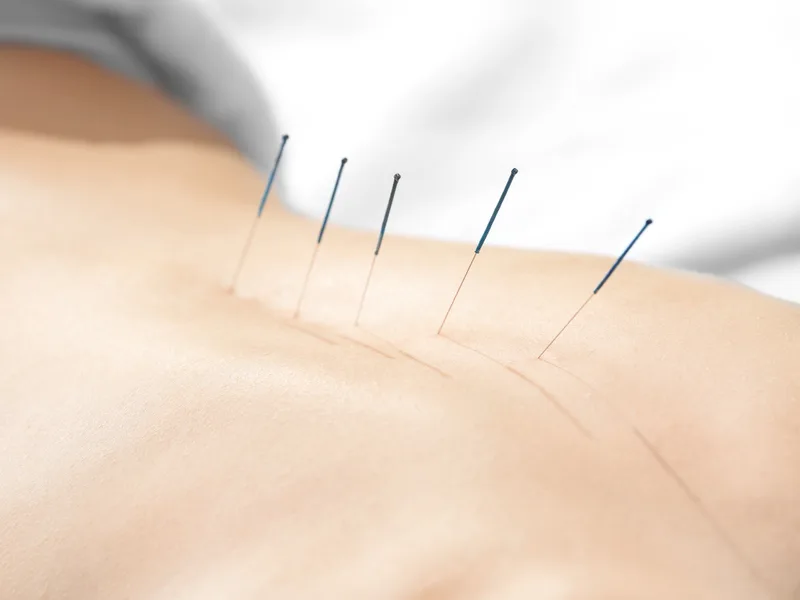 Acupuncture at Sarasota Auto Injury Clinic in Sarasota