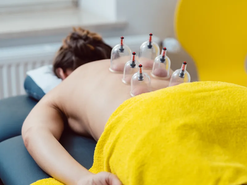 Cupping Therapy at Sarasota Auto Injury Clinic in Sarasota