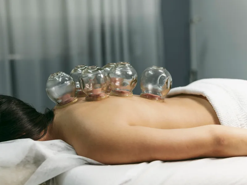 Cupping Therapy at Sarasota Auto Injury Clinic in Sarasota