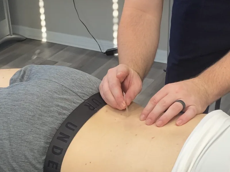 How Dry Needling works at Sarasota Auto Injury Clinic