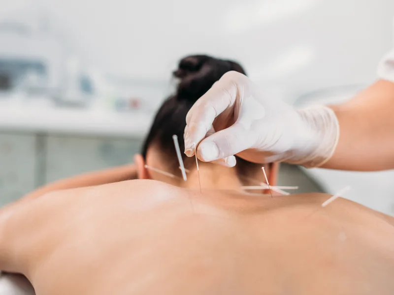 Dry Needling at Sarasota Auto Injury Clinic in Sarasota